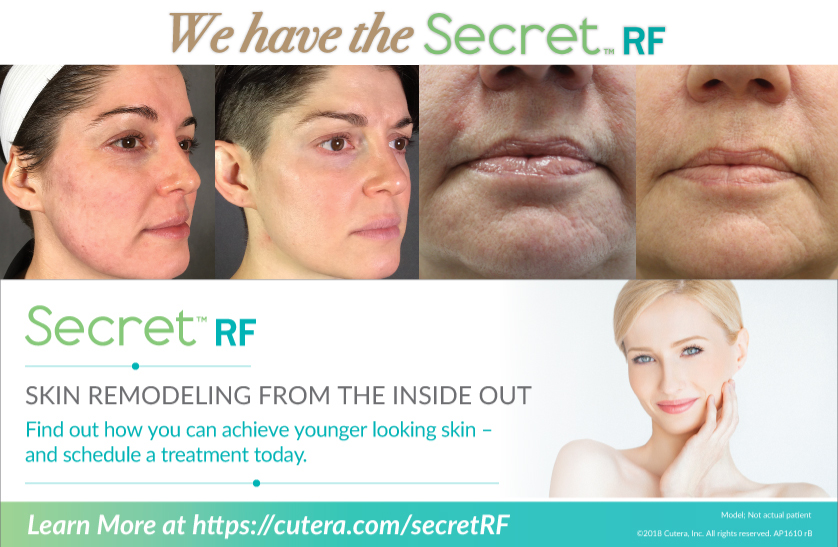 SecretRF ance treatment laser info graphic